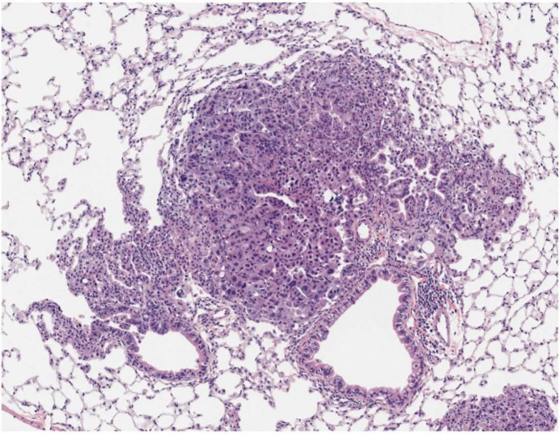 肺癌血染色切片