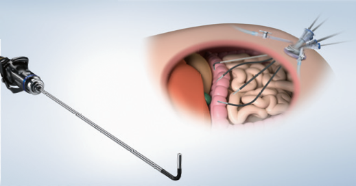 腹腔内窥镜单孔手术