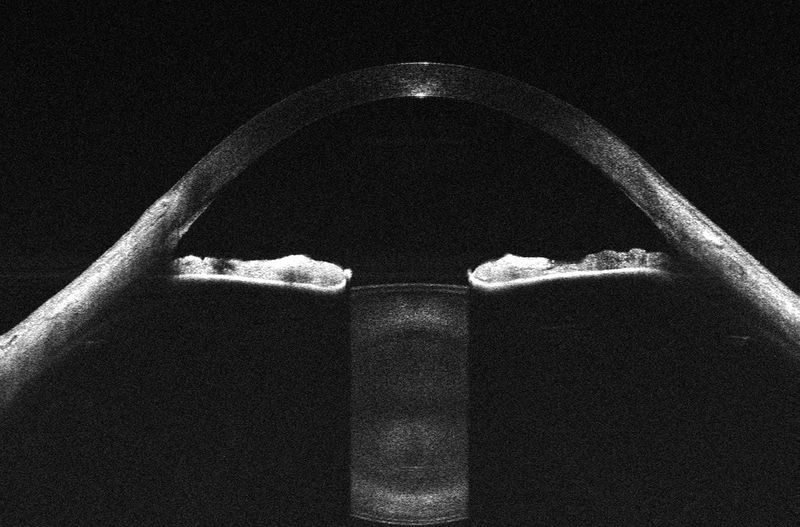 EnFocusOCT֯еĳΪ11ףԿǰͼ