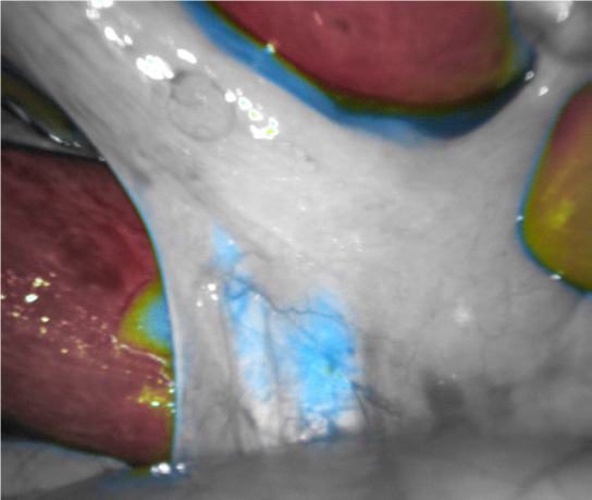 腹腔镜胆囊切除术中的SPY CSF（彩色分段荧光）模式