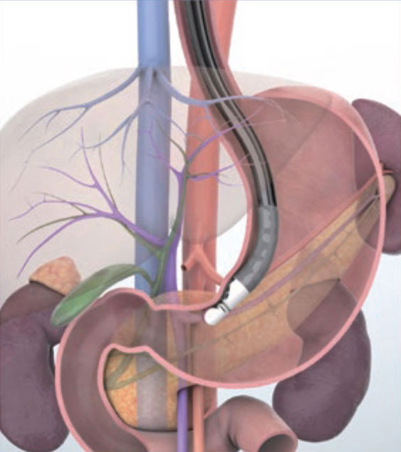 肝门部（门静脉、胆管）