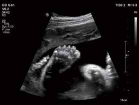 Affiniti_70_FETAL_FOOT.jpeg
