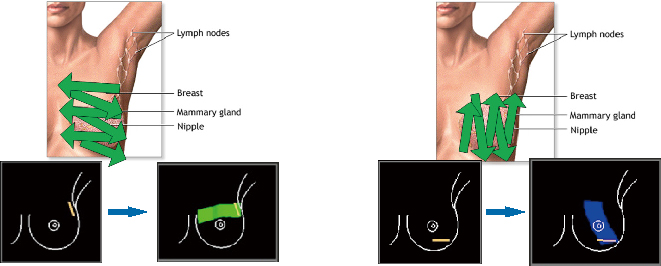 AI_Breast