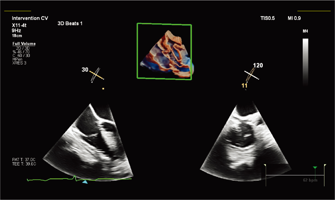 X11-4t&nbsp;̽ͷ��&nbsp;TrueVue&nbsp;Glass&nbsp;���������&nbsp;MPR&nbsp;����