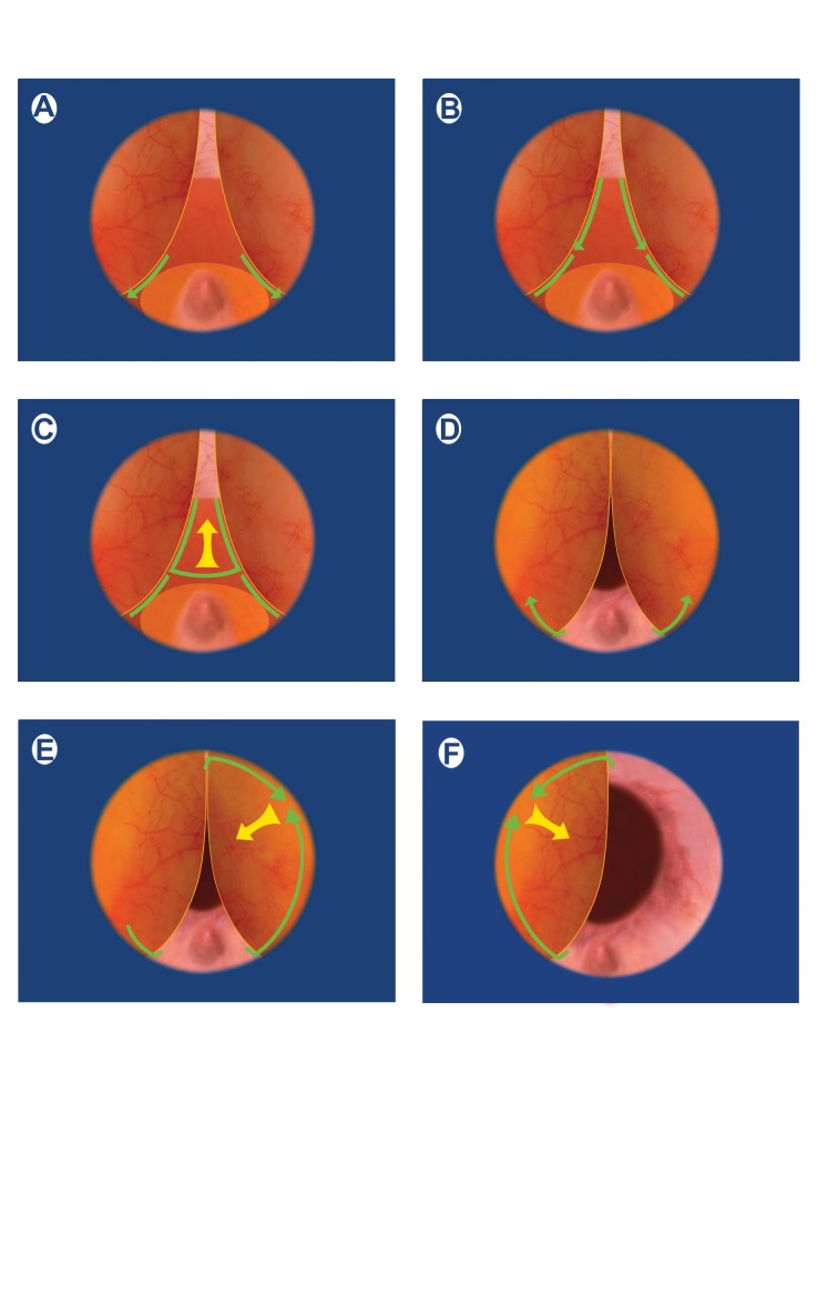 经尿道前列腺电切术（TURP）