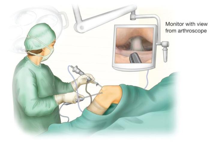 什么是微创膝关节镜手术？